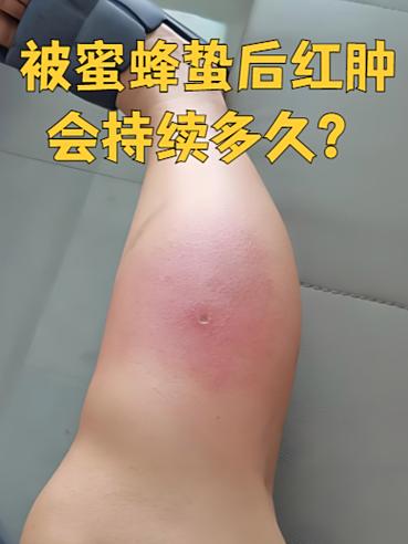 被大黄蜂咬了怎么办?